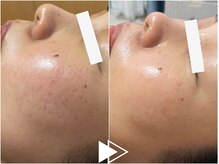 リシェス(Richesse)/毛穴改善ハーブ★初回¥9990