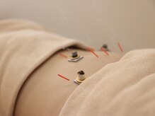 美鍼堂/自律神経と整える鍼灸