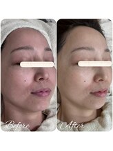 ビースキン(be-skin)/ララピールbefore→after