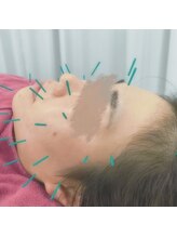 ハリマル(HARIMARU)/美容鍼灸施術