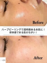 毛穴ラボ 梅田(毛穴LABO)&nbsp;1回でお肌 白玉肌★