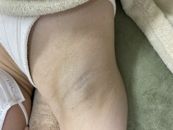 ナノハナ/鹿沼市全身脱毛美容室ナノハナ