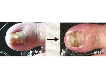 爪切り屋 足楽 日本橋三越前店/巻き爪1