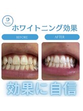 R24 梅田店/ホワイトニング効果