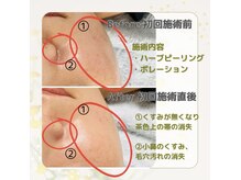 リラキュート(Rela Cute)/ハーブピーリング