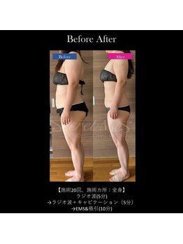 フェレザ 新潟(Felleza)/新潟-痩身エステ-BODYエステ