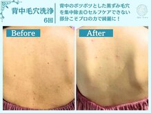 フローフシ∞/【背中毛穴洗浄】毛穴黒ずみ改善