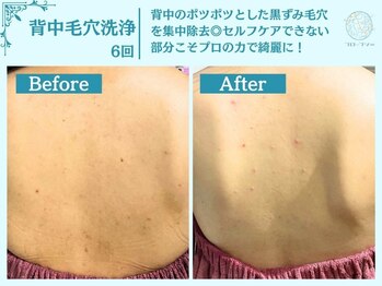 フローフシ∞/【背中毛穴洗浄】毛穴黒ずみ改善