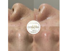 【毛穴エクストラクション】黒ずみ・詰まりに徹底アプローチする毛穴ケア