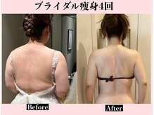 【ブライダル痩身4回】脂肪取/骨格矯正