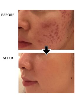 サロンドボーテ ノンノン(Salon de Beaute Non-non)/ニキビケアコース