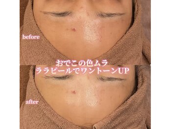 アクトベレッザ(Act BELLEZZA)/乾燥日焼けの色ムラにララピール