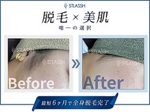 ストラッシュ 奈良店(STLASSH)/メニュー：全身脱毛（もみあげ）
