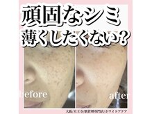 ホワイトアクア 天王寺本店(WHITE AQUA)/ララピールで肌荒れ改善/天王寺