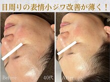 ぷるる 練馬 江古田/40代　ララ＋ゲルマスク導入