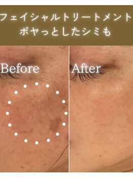 ココロ(COCORO)/シミケア&美白トーニング