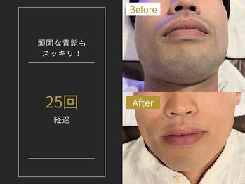 ステイゴールド 新百合ヶ丘(STAY GOLD)/おヒゲ脱毛の経過☆