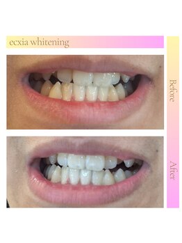 エクシアホワイトニング 三宮駅前店/ホワイトニングビフォーアフター