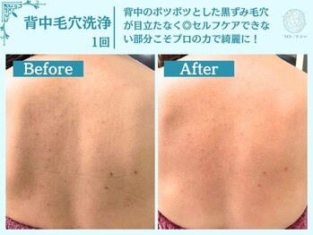 フローフシ∞/【背中毛穴洗浄】毛穴黒ずみ改善