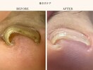 巻き爪改善ケア