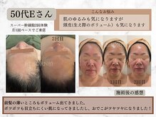 リボーン 柏(REBORN)/【40代50代向け】スーパ幹細胞