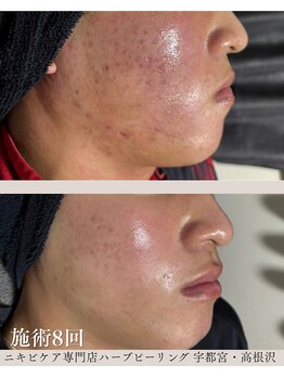 ハーブピーリングHYの写真/【学割U24】安全な施術を心掛けています◎ハーブピーリングでニキビ・毛穴ケア！家族みんなで美肌に！