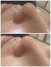 毛穴洗浄韓国肌管理/1回6,600円→5,000円/小顔たるみニキビ肌黒ずみ