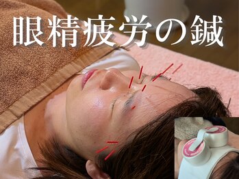 もりさわ治療院 与力町治療室  トサカ(TOSAKA)の写真/PCやスマホ疲れが気になる方に!高知希少の【ルート鍼×水素灸】で蓄積された眼精疲労解消!【鍼灸】