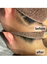 セイリキ(SEIRIKI)/うなじ脱毛