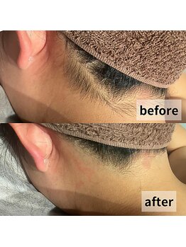 セイリキ(SEIRIKI)/うなじ脱毛