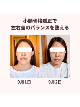 プレシャス(PRECIOUS)/小顔矯正