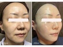 リプラス(Replus)の雰囲気（【次世代レチノール】バクチオールピーリングでうる艶水光肌に♪）