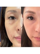 ギンザロッソ(GINZA ROSSO)/エクソソームフェイシャル