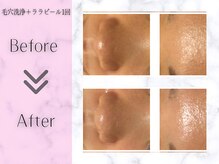 リライフ(ReLIFE)/韓国肌管理/毛穴洗浄+ララピール