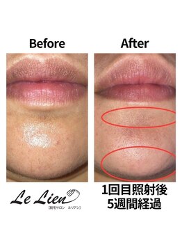 ルリアン(Le Lien)/【レディース】お顔症例