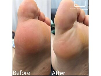 ハイリー(Hily)/松縄 角質ケア