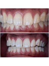 エクシアホワイトニング 代々木店/ホワイトニングビフォーアフター