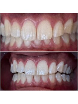 エクシアホワイトニング 代々木店/ホワイトニングビフォーアフター