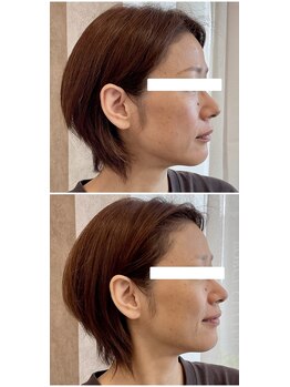 ニコワ(Nicowa)/Nicowaのコルギ★BeforeAfter