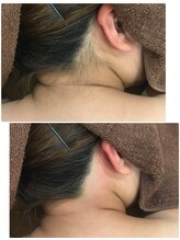 叶(Kanau)/うなじ脱毛