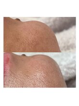 ポレ(pole)/毛穴悩みも解決