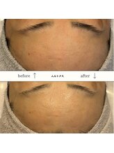 ビーエヌ エステティックアンドスパ(BN Esthetic&Spa)/60代おでこのしわもしっかりケア