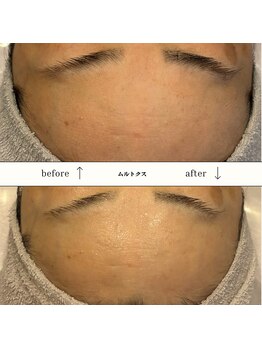 ビーエヌ エステティックアンドスパ(BN Esthetic&Spa)/60代おでこのしわもしっかりケア