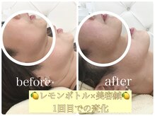 アキュモンド 渋谷院(acumond)/《たるみ改善》二重顎スッキリ