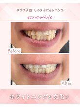 エクシアホワイトニング 浜松店/ホワイトニングビフォーアフター