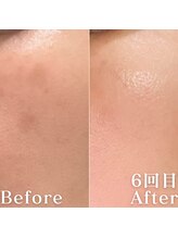 ミニョスキンラボ/ダクトピール6回