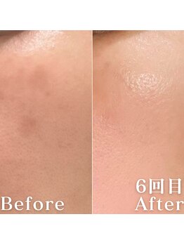 ミニョスキンラボ/ダクトピール6回