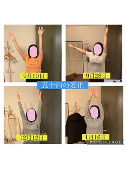 甲陽園鍼灸わたぐも/五十肩の改善