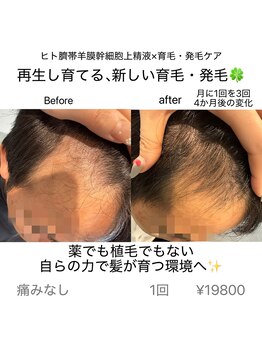 リノア(Lino’a)の写真/メンズにオススメのサロン◎ヒト臍帯羊膜幹細胞上精液で、自らの力で髪が育つ環境へ!