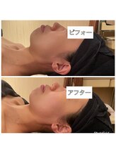 小顔フェイスラボ 浜松店(小顔FaceLabo.)/【実際の変化】小顔&整体コルギ